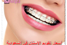 أسعار تقويم الاسنان في السعودية