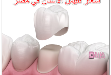 أسعار تلبيس الاسنان في مصر