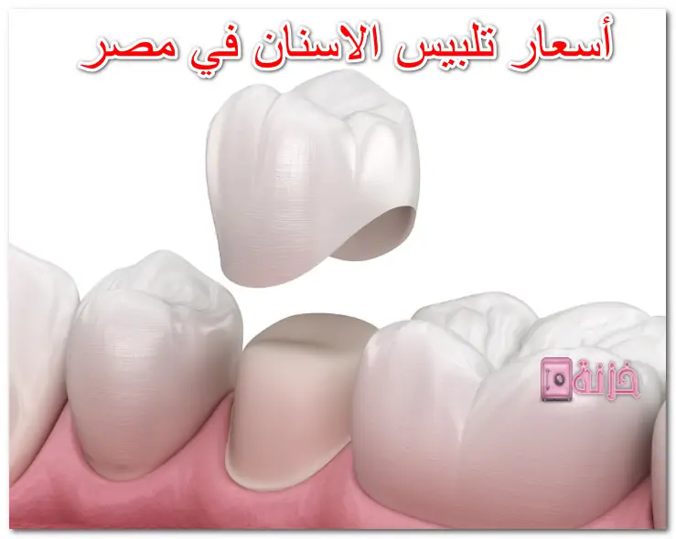 أسعار تلبيس الاسنان في مصر